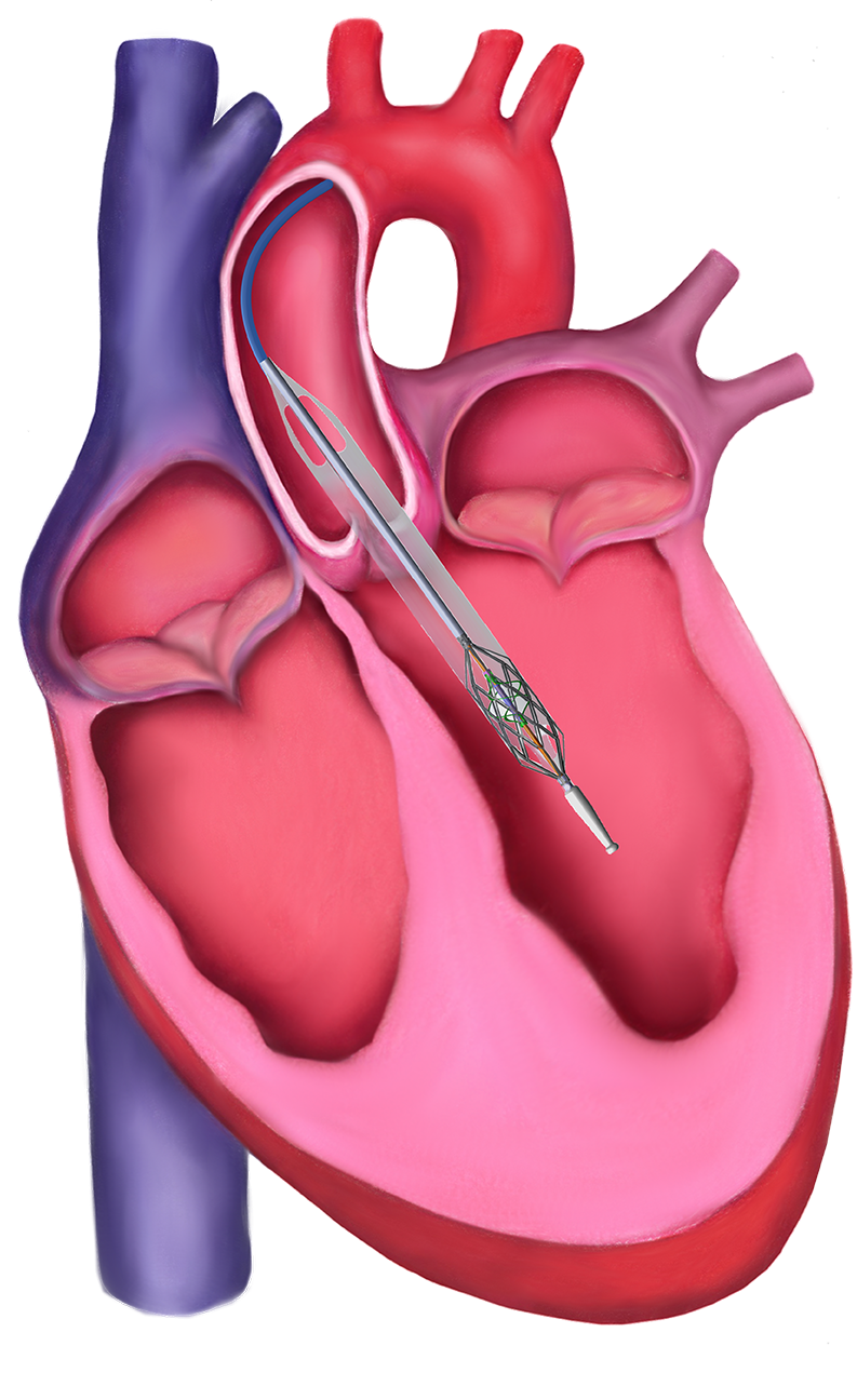 Magenta Medical Raises $55M for World&rsquo;s Smallest Heart Pump